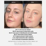 RED ACNE SUCCINIC ACID PEEL - 40G - Image 4